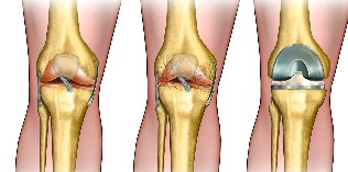 what is osteoarthritis