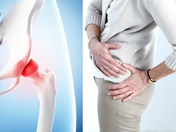 Symptoms of osteoarthritis of the hip joint