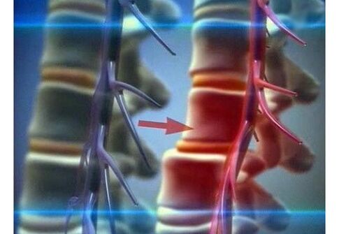 Crushing of nerve endings in lumbar osteochondrosis