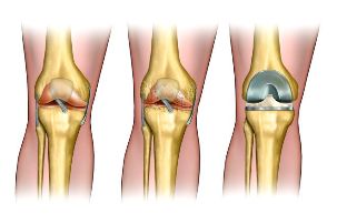 the degree of osteoarthritis