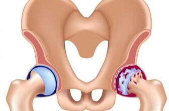 Development stages of the arthrosis of the hip joint
