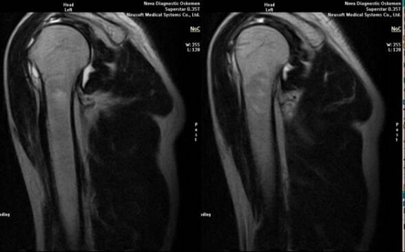 X-ray to diagnose shoulder arthrosis